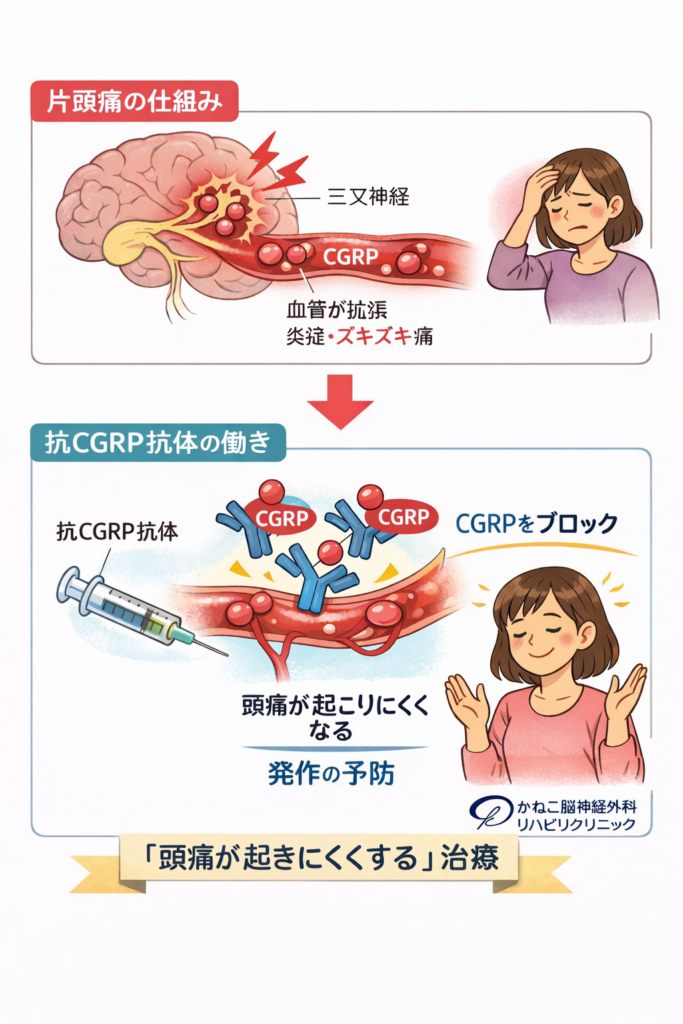 片頭痛の治療法｜抗CGRP抗体とは？効果・副作用を解説 | 伊丹市